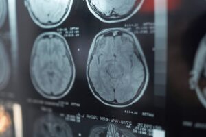 Close up of brain MRI scans displaying diagnostic imaging for neurological examination and clinical analysis.